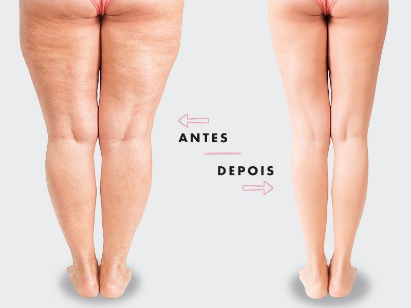 fotos de antes e depois da lipoaspiração do culote