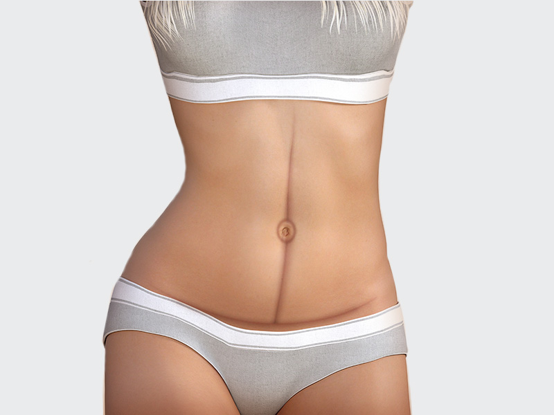 Localização da cicatriz abdominoplastia em âncora ilustração da cicatriz abdominoplastia ancora