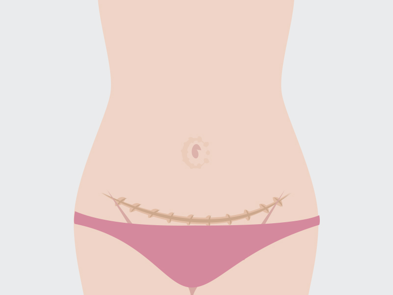 ilustração da cicatriz hipertrófica abdominoplastia