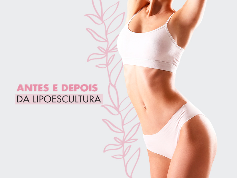 Lipoescultura antes e depois: tudo o que você precisa saber para ter o resultado dos sonhos! lipoescultura antes depois
