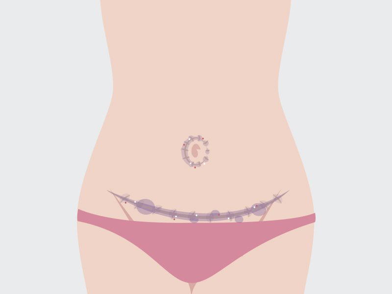 ilustração da abdominoplastia cicatriz com queloide