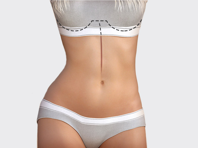 Localização da abdominoplastia reversa ilustração da cicatriz abdominoplastia reversa