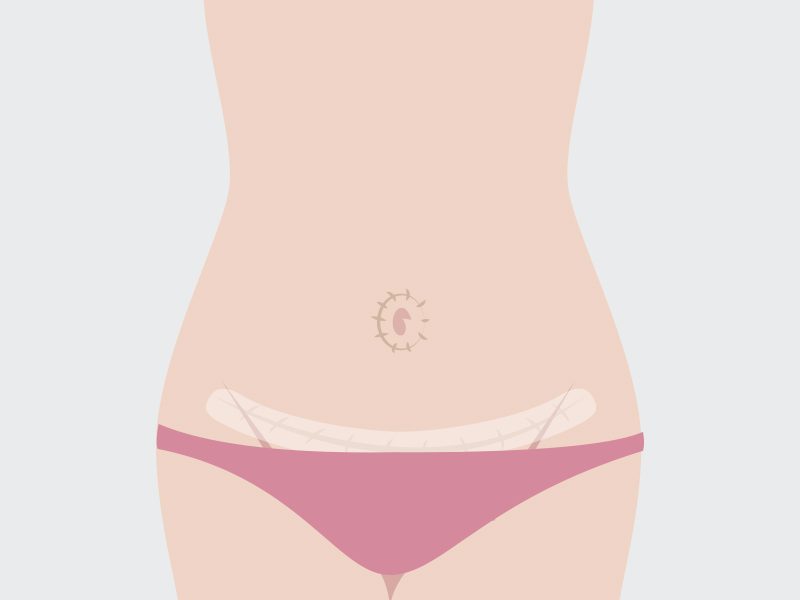 ilustração da fita silicone cicatriz abdominoplastia