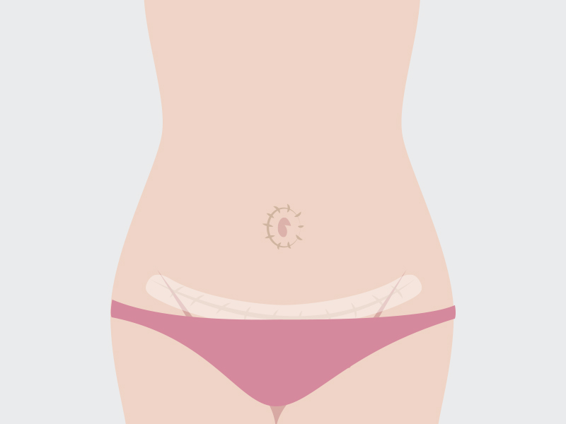 Fita de silicone para cicatriz de abdominoplastia ilustração da fita silicone cicatriz abdominoplastia