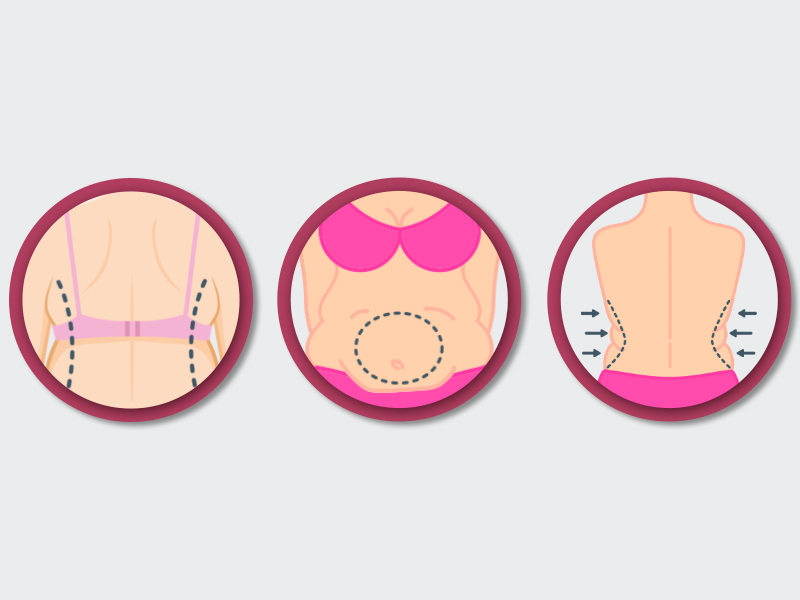 Ilustração mostrando as regiões de retirada de gordura na lipo 360: costas, barriga e flancos.