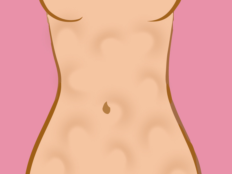 Fibrose após lipo tem tratamento? fibrose pos lipo