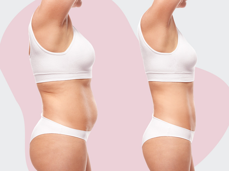 Imagem de uma mulher mostrando seu antes e depois da lipoaspiração na barriga