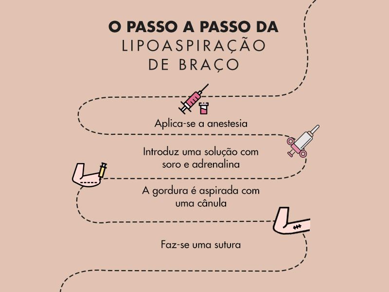 infográfico com o passo a passo da cirurgia para retirar a gordura do braço. Mostra a aplicação da anestesia, a introdução da solução de adrenalina, a gordura aspirada e a realização da sutura.