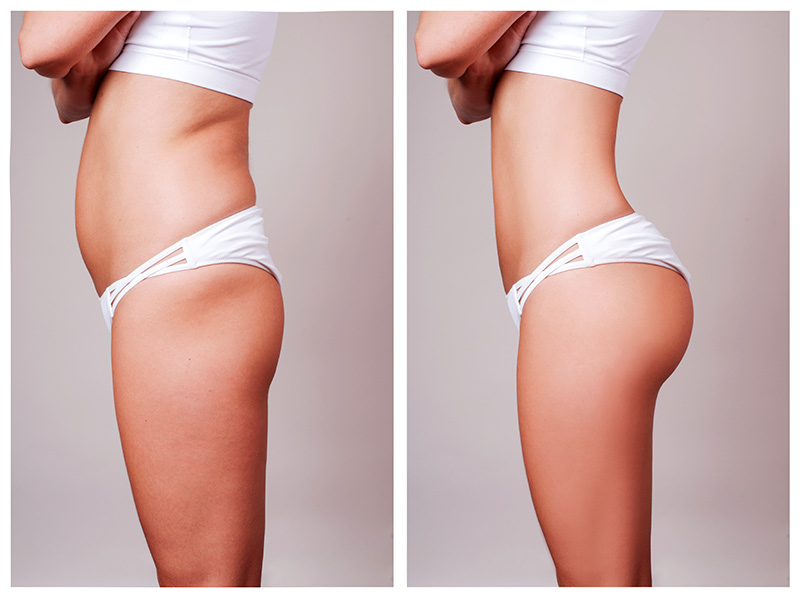 Lipoescultura com enxerto nos glúteos: veja os antes e depois! lipoescultura antes e depois fotos