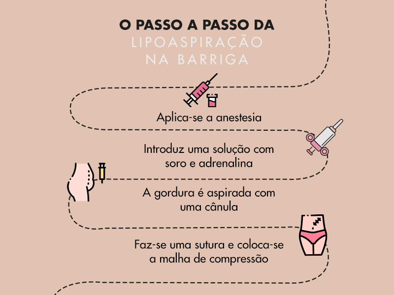 Ilustração explicando todos os passos de como é feita a lipo no abdômen