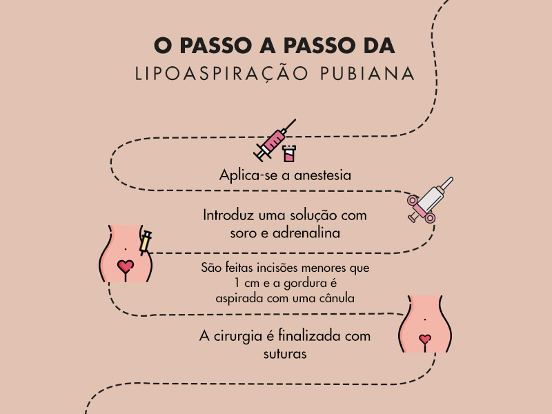 olustração com o passo a passo da lipoaspiração pubiana, desde aplicar anestesia, solução de adrenalina, incisão e suturas