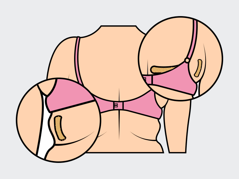 Ilustração mostrando as regiões onde geralmente há acúmulo de gordura nas costas