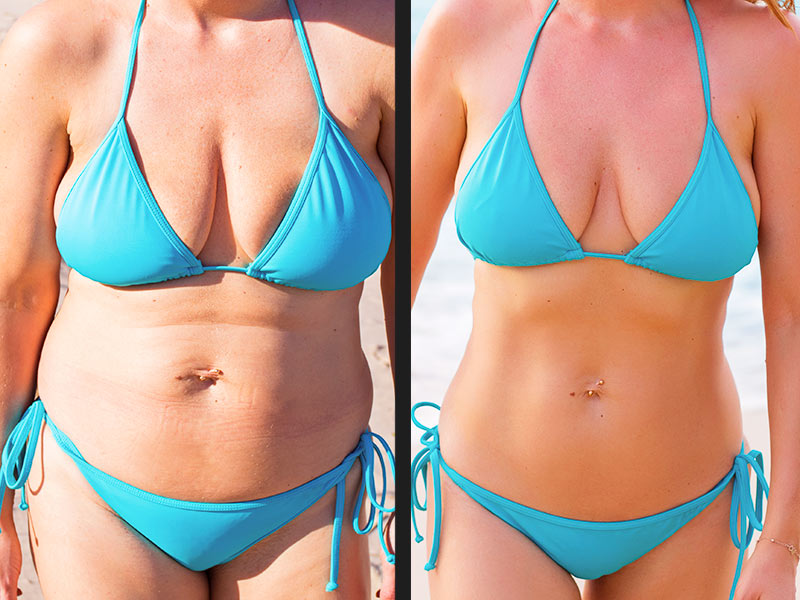 Imagem mostrando o antes e depois da barriga lipada de uma mulher branca, usando biquíni azul.