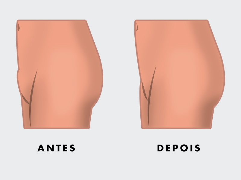 ilustração com o antes e depois da lipoaspiração do monte de vênus