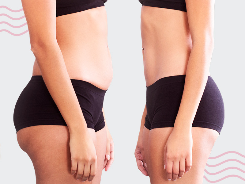 Lipoenxertia glútea, antes e depois em imagens lipoescultura enxerto gluteo antes depois