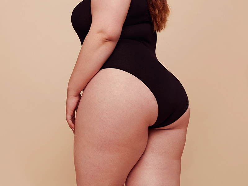Lipo na papada, braços e coxas: é perigoso? lipo papada perigoso