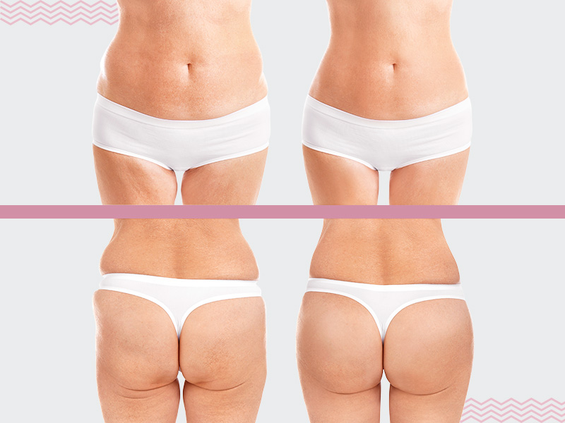 Lipoenxertia glútea antes e depois lipoenxertia de gluteos antes e depois
