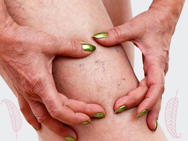 Trombose pós-cirúrgica trombose apos cirurgia lipoaspiracao