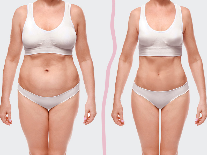 Foto de lipoescultura antes e depois lipoescultura antes depois imagens