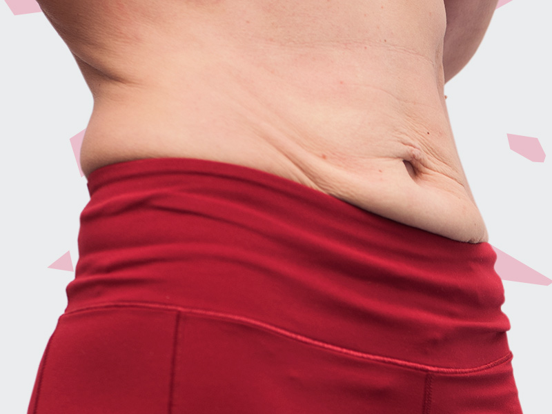 Lipoaspiração deixa a pele flácida? barriga flacida apos lipoaspiracao