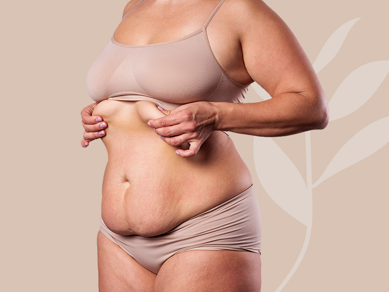 abdominoplastia pelo sus