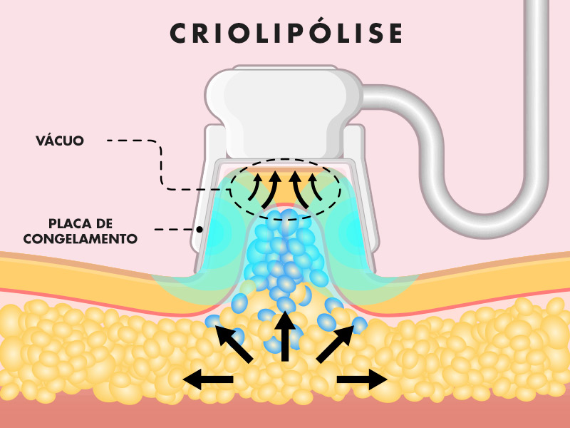 Ilustração que mostra o que é a Criolipólise e como ela funciona no corpo