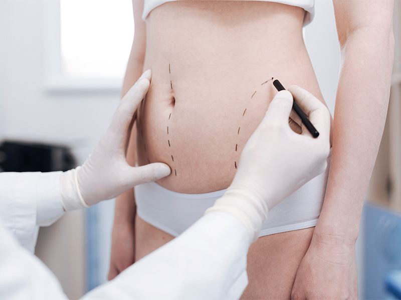 Quais os tipos de lipo LAD? tipos lipo lad