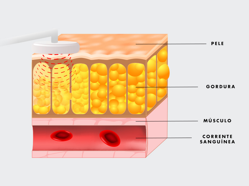 Ilustração que mostra como a lipo sem corte funciona no corpo