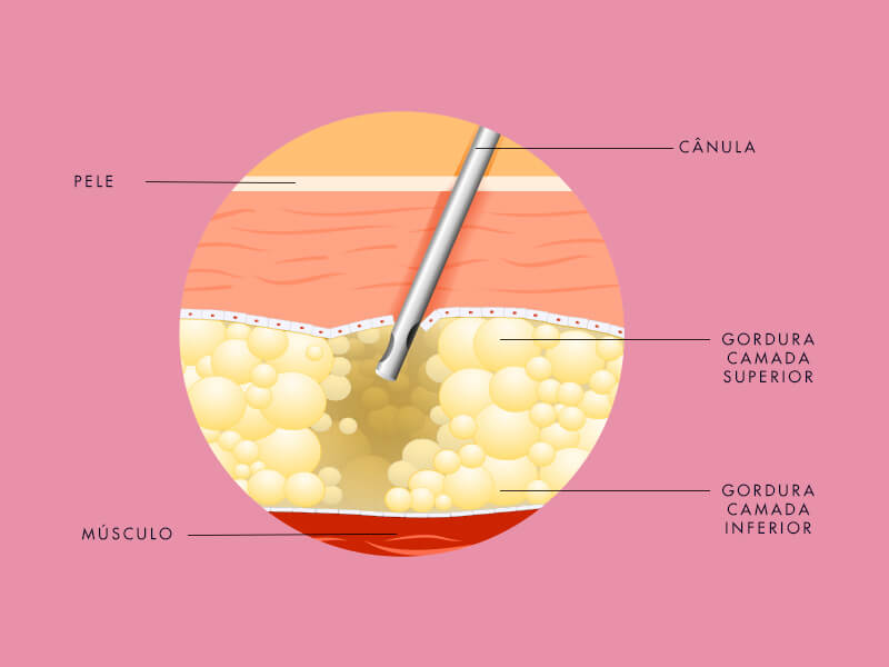 Como funciona a Lipo LAD 3D lipo 3d como funciona