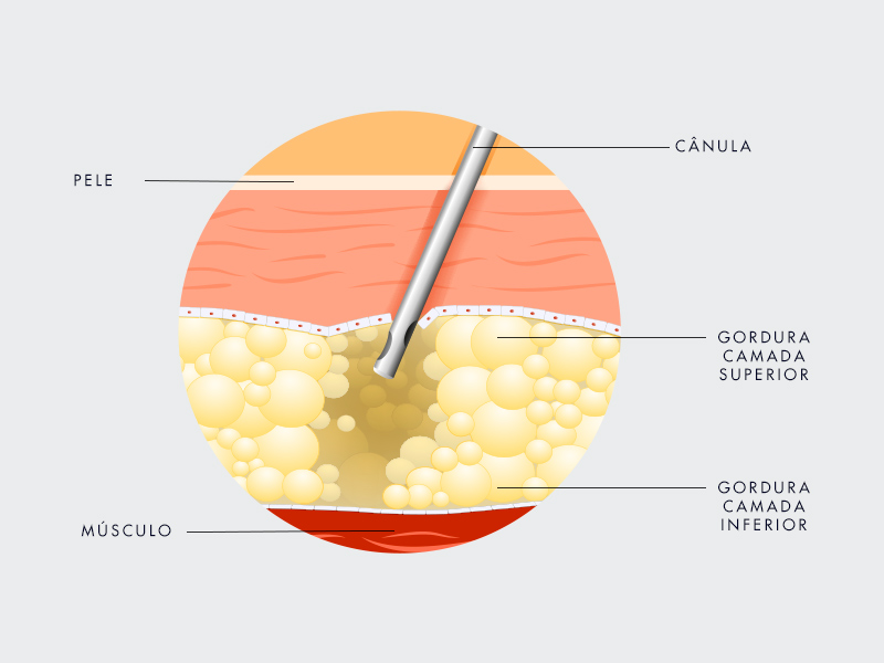 Como é feita a Lipo LAD? lipo hd como funciona