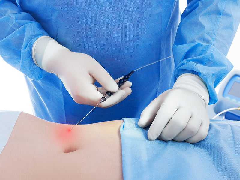 Quanto custa uma lipo HD? quanto custa lipo lad