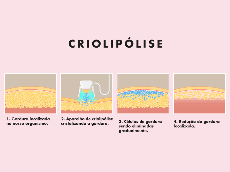 Ilustração com o passo a passo da criolipólise