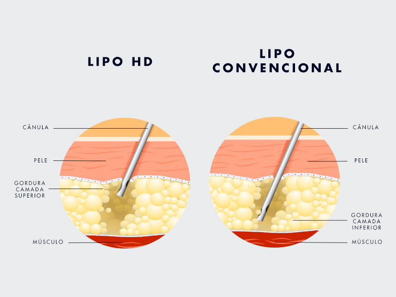 Qual a diferença da Lipo HD para a Lipoaspiração? lipo lad lipoaspiracao convencional