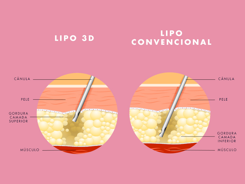 A principal diferença entre Lipo 3D e Lipoaspiração está na segurança da paciente! lipo em 3d