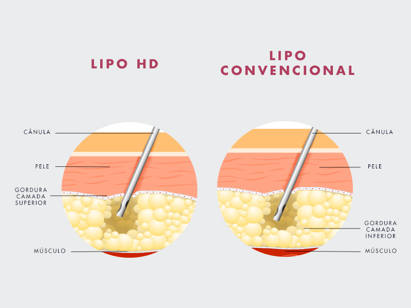 diferença lipo comum lipo lad