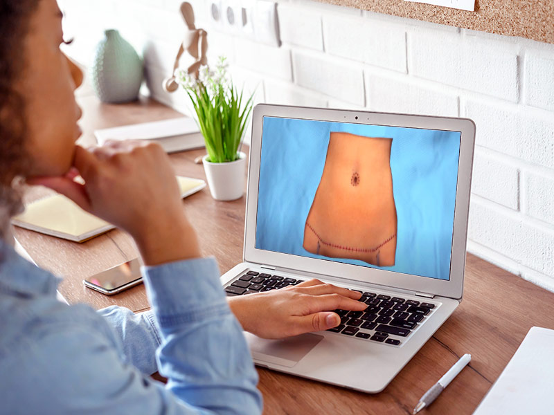 Vídeo Abdominoplastia: finalizando o procedimento! vídeo cirurgia abdominoplastia passo 5: é feita a cicatriz e fechada a ferida