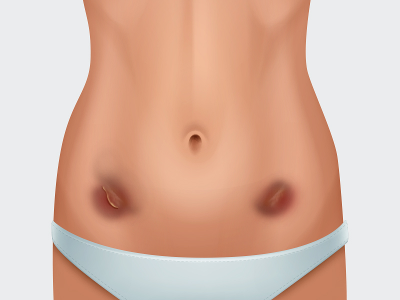 Riscos de Necrose necrose lipo 3D