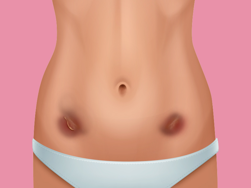 Necrose na Lipo de alta definição necrose lipo LAD