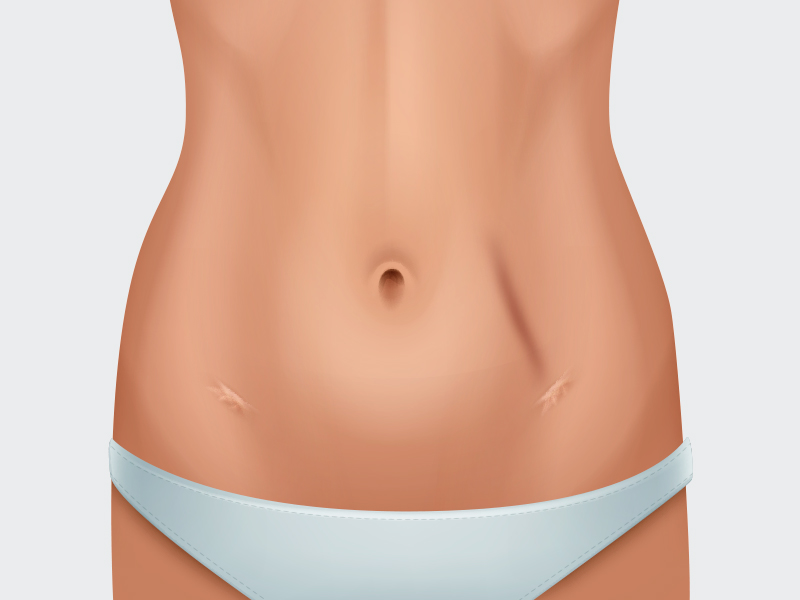 Riscos de Queimadura queimadura lipo 3d