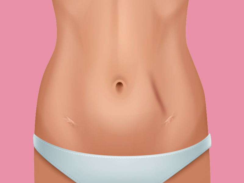 Queimadura na pele por Lipo HD queimadura lipo alta definicao