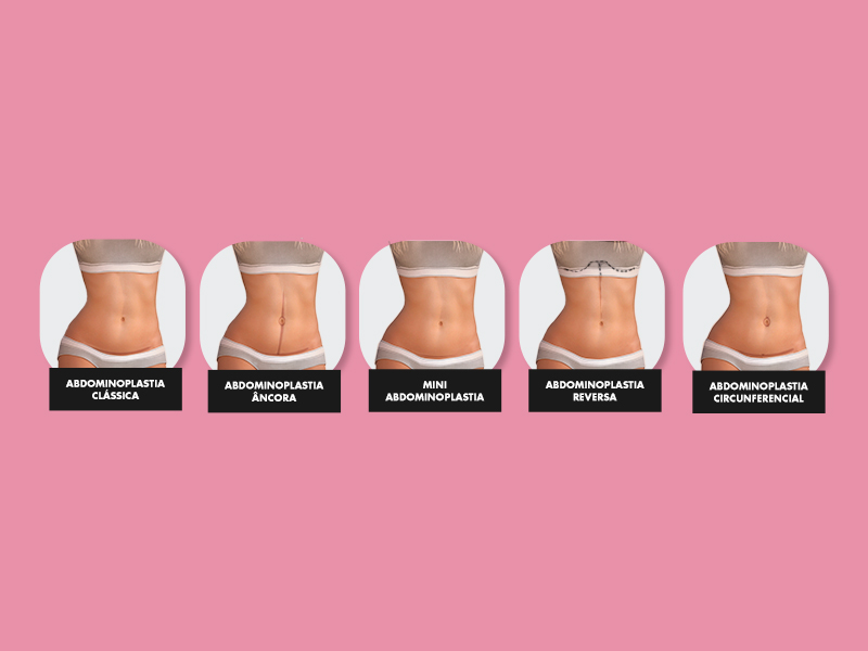 ilustração de recorte do vídeo de abdominoplastia com cada cicatriz