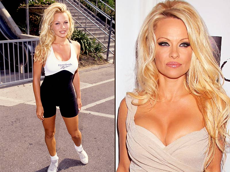 400 ml de silicone da Pamela Anderson