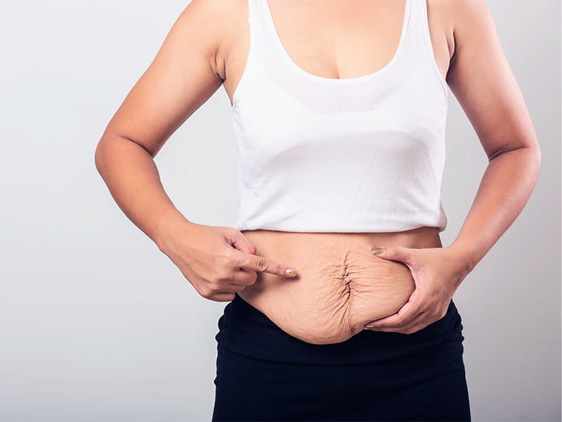 A lipo HD é indicada para quem tem flacidez na barriga? mulher flacidez barriga