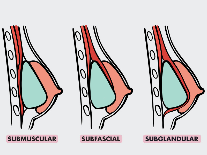 Prótese de silicone tipos de alojamento protese silicone grande