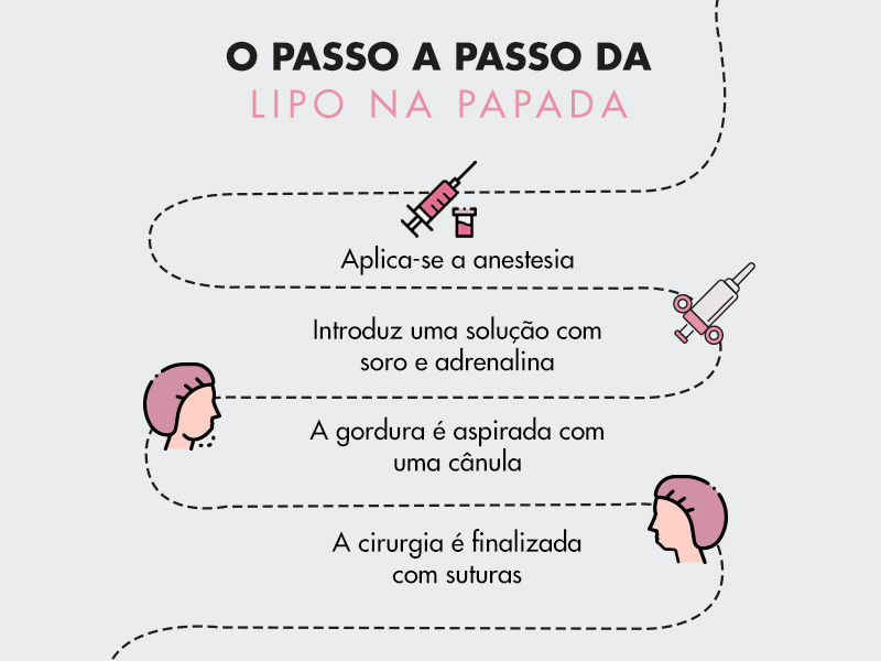 ilustração com o passo a passo da cirurgia de lipo de papada