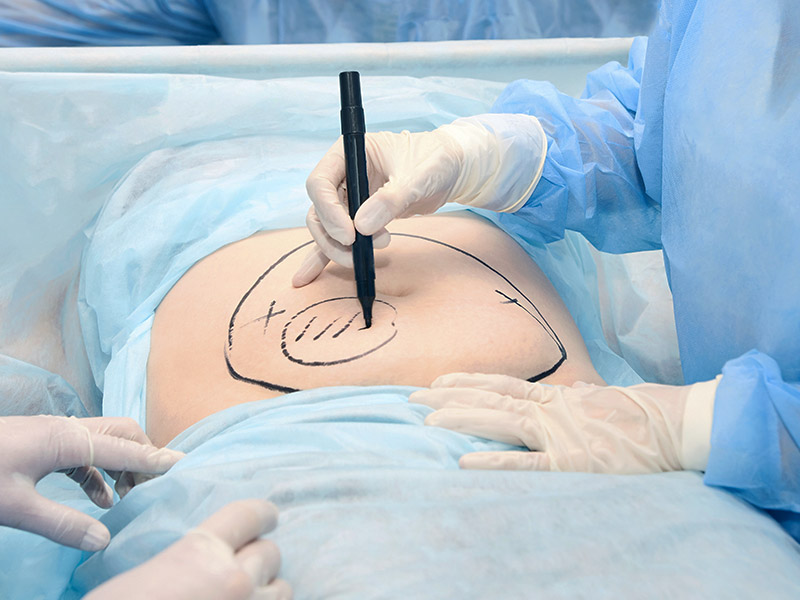 Imagem de um paciente no centro cirúrgico enquanto o cirurgião plástico faz marcações em sua barriga antes de realizar uma lipoaspiração