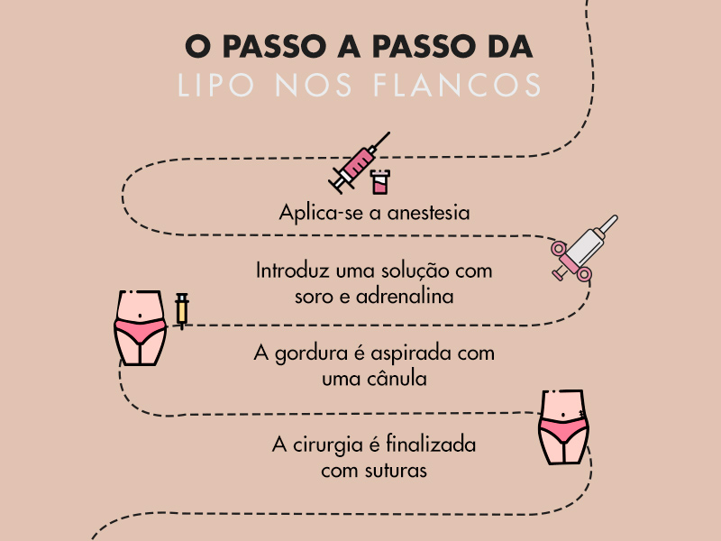 Ilustração de como é feita a lipo nos flancos, sendo que o primeiro passo é aplicar anestesia, depois introduzir uma solução de soro e adrenalina na gordura localizada, depois aspirar a gordura e por fim as suturas são feitas.