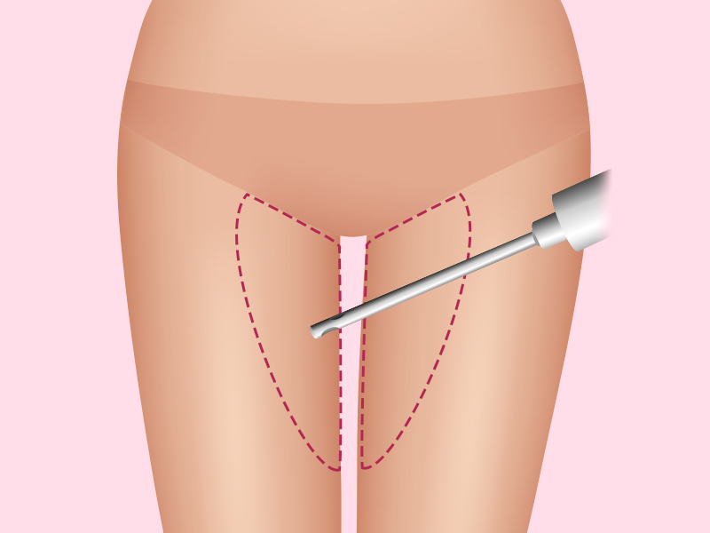 ilustração mostrando a região da lipoaspiração da coxa