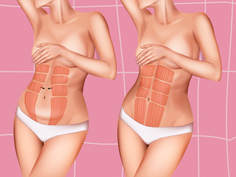 Ilustração que mostra o antes e depois dos pontos internos da abdominoplastia, chamado de plicatura