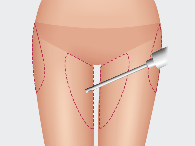 ilustração mostrando onde fica a lipo na perna